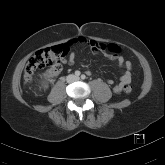 File:Breast metastases from renal cell cancer (Radiopaedia 79220-92225 C 65).jpg