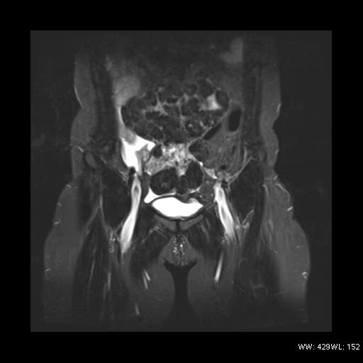 File:Broad ligament fibroid (Radiopaedia 49135-54241 Coronal STIR 7).jpg