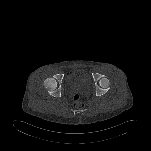 Brodie abscess- femoral neck (Radiopaedia 53862-59966 Axial bone window 135).jpg