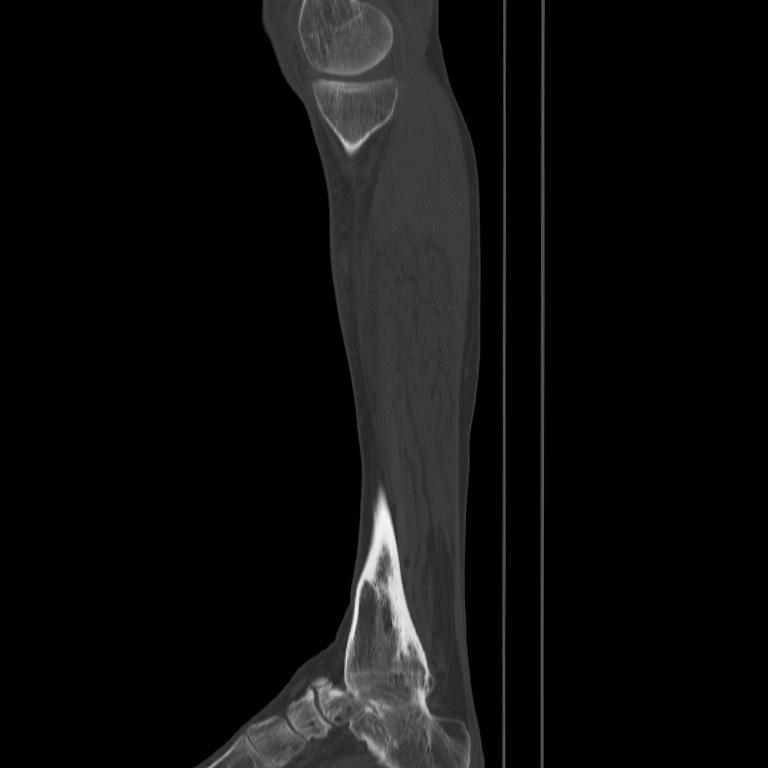 Brodie abscess - tibia (Radiopaedia 66028-75204 Sagittal bone window 11).jpg