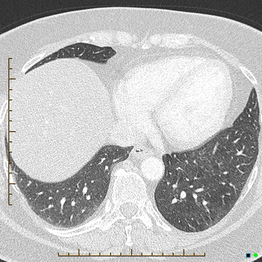 Bronchial diverticula (Radiopaedia 79512-92676 Axial lung window 156).jpg