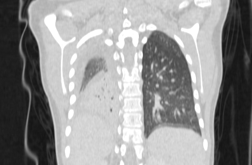 Bronchial mucoepidermoid carcinoma (Radiopaedia 57023-63895 Coronal lung window 76).jpg