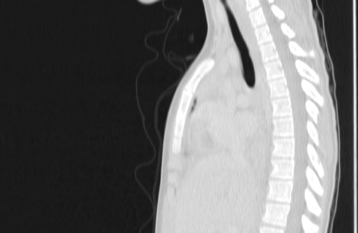 File:Bronchial mucoepidermoid carcinoma (Radiopaedia 57023-63895 Sagittal lung window 76).jpg