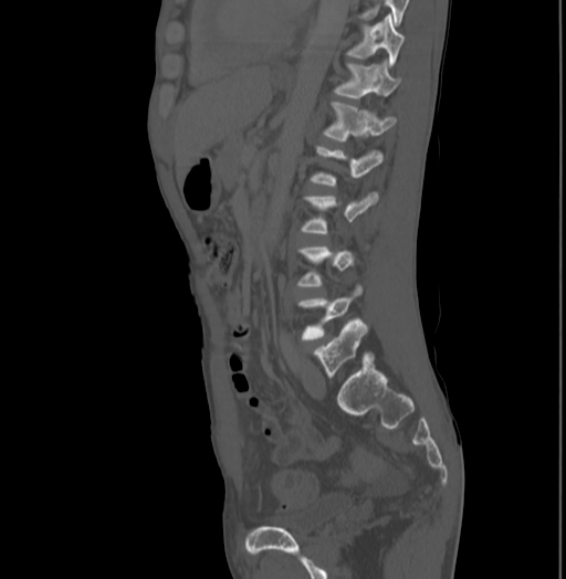 Bronchiectasis in Crohn disease (Radiopaedia 60311-67977 Sagittal bone window 150).jpg