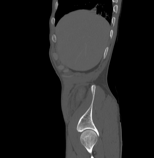 Bronchiectasis in Crohn disease (Radiopaedia 60311-67977 Sagittal bone window 5).jpg
