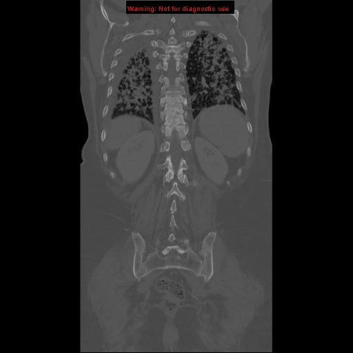 File:Bronchoalveolar carcinoma (Radiopaedia 13224-13233 Coronal non-contrast 24).jpg
