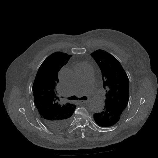 Bronchogenic carcinoma with metastatic lymphadenopathy (Radiopaedia 37671-39569 Axial bone window 22).jpg