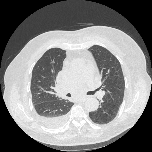 Bronchogenic carcinoma with metastatic lymphadenopathy (Radiopaedia 37671-39569 Axial lung window 26).jpg