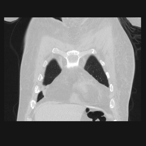 File:Bronchogenic carcinoma with metastatic lymphadenopathy (Radiopaedia 37671-39569 Coronal lung window 8).jpg