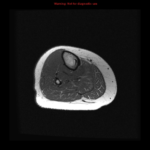 File:Brown tumor (Radiopaedia 12318-12597 Axial T1 23).jpg