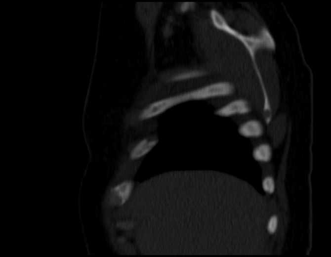 Brown tumors compressing the spinal cord (Radiopaedia 68442-77988 Sagittal bone window 10).jpg