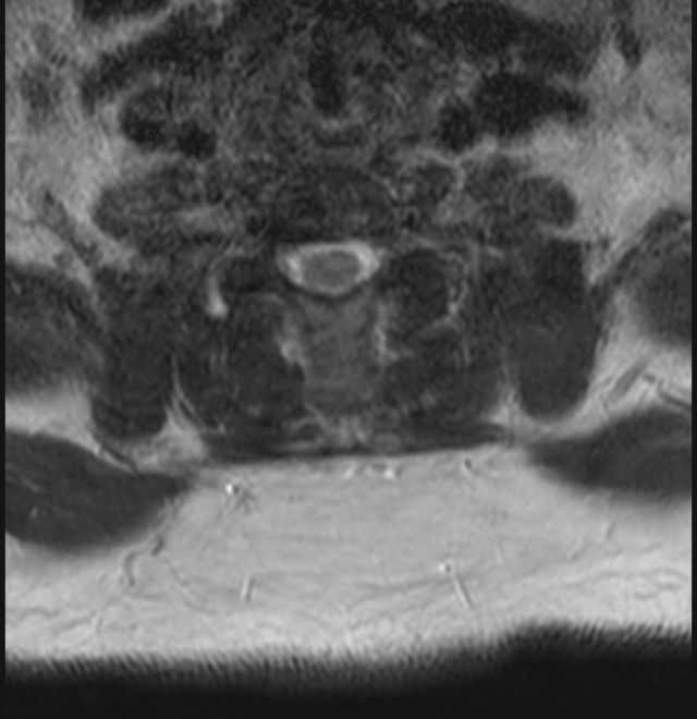 Brown tumors compressing the spinal cord (Radiopaedia 68442-78030 A 59).jpg