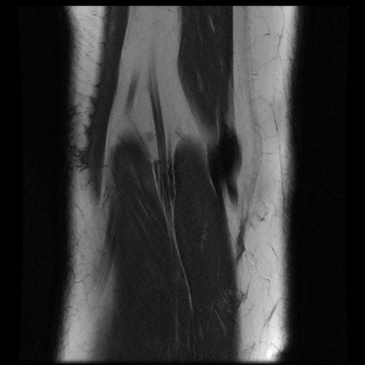 File:Bucket handle meniscus tear (Radiopaedia 56916-63751 Coronal T1 18).jpg