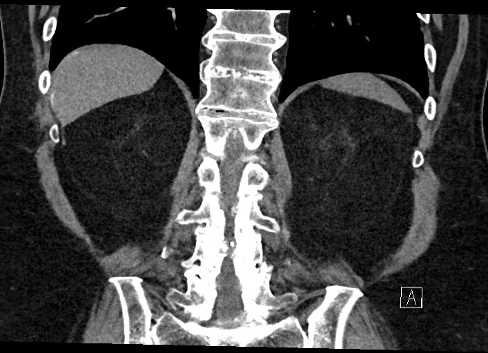 Buried bumper syndrome - gastrostomy tube (Radiopaedia 63843-72577 Coronal Inject 105).jpg