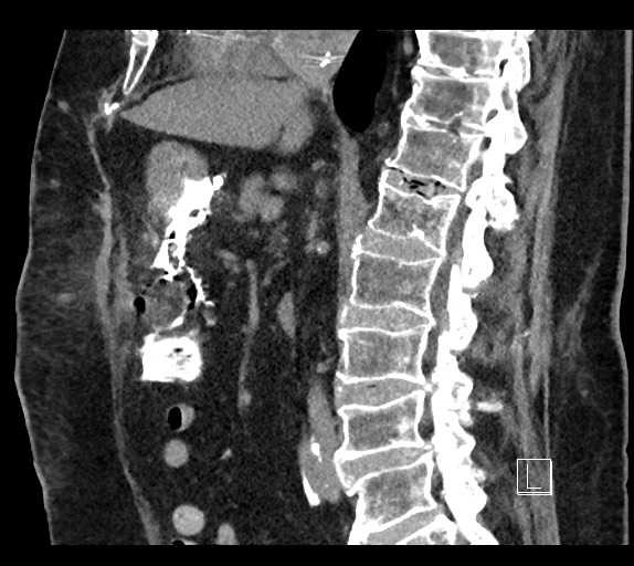 Buried bumper syndrome - gastrostomy tube (Radiopaedia 63843-72577 Sagittal Inject 63).jpg