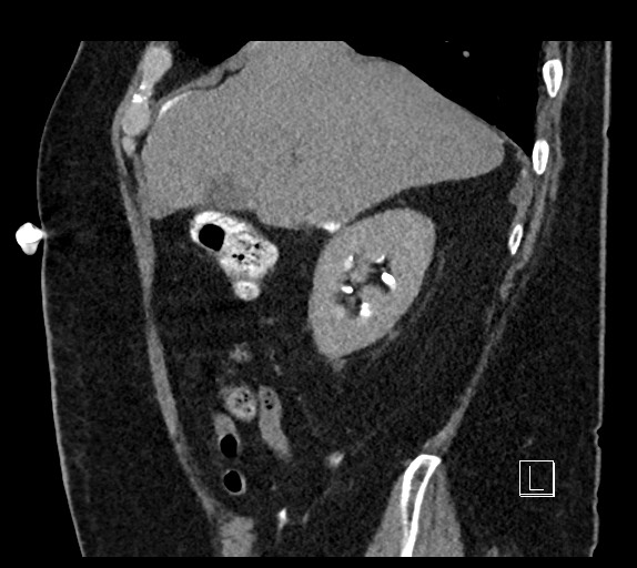 Buried bumper syndrome - gastrostomy tube (Radiopaedia 63843-72577 Sagittal Inject 92).jpg
