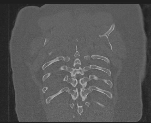 Burst fracture - thoracic spine (Radiopaedia 30238-30865 Coronal bone window 143).jpg