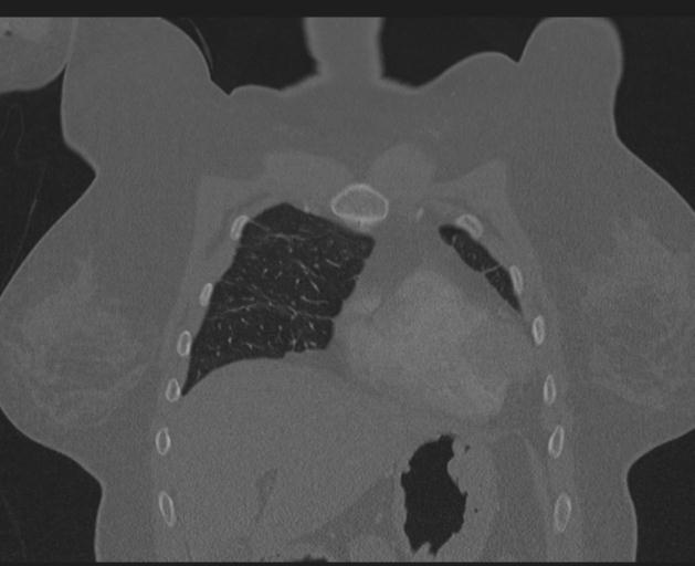 Burst fracture - thoracic spine (Radiopaedia 30238-30865 Coronal bone window 39).jpg