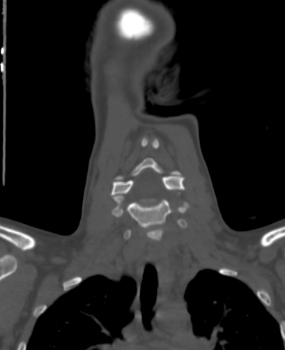 File:Butterfly vertebra (Radiopaedia 77903-90209 Coronal bone window 21).jpg