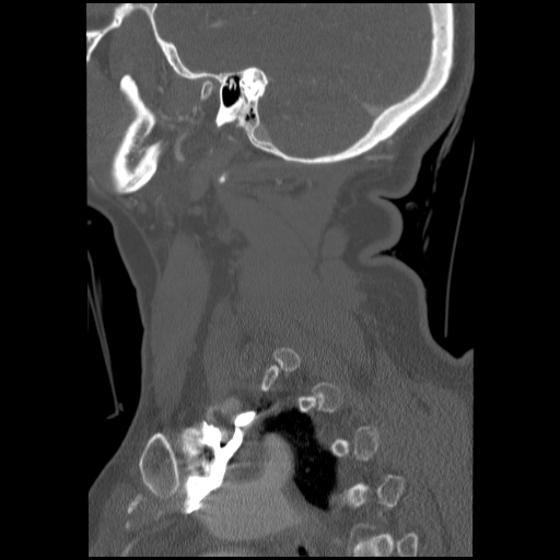 File:C1 anterior arch (plough) fracture - type 1 (Radiopaedia 76181-87720 Sagittal bone window 28).jpg
