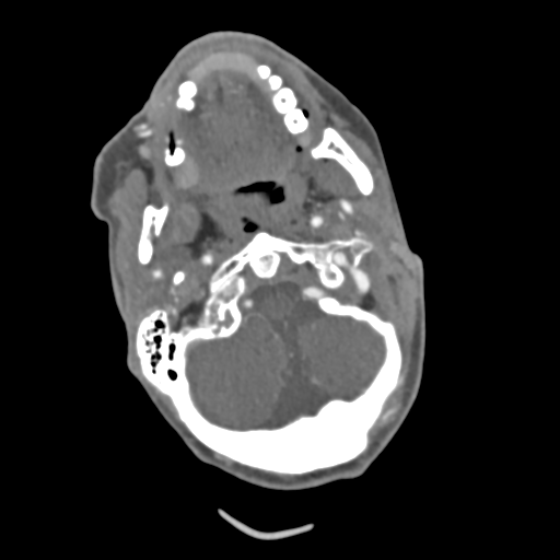 File:C2 fracture with vertebral artery dissection (Radiopaedia 37378-39200 A 182).png