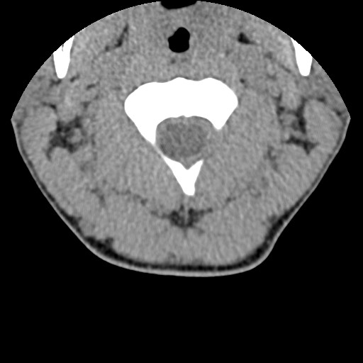 File:C5 facet fracture (Radiopaedia 58374-65499 Axial non-contrast 22).jpg