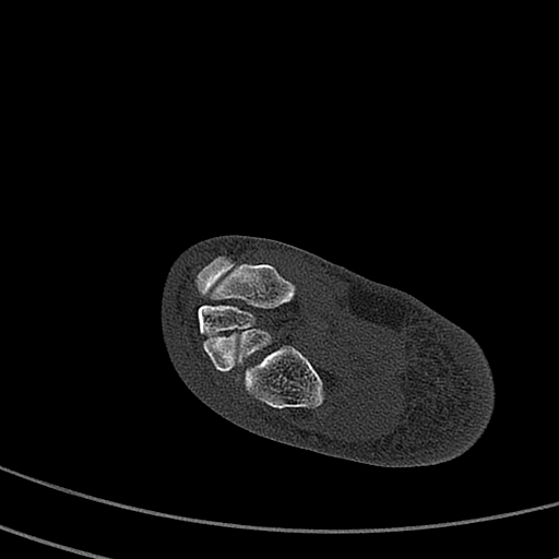 Calcaneal fracture - Sanders type 4 (Radiopaedia 90179-107370 Axial bone window 43).jpg
