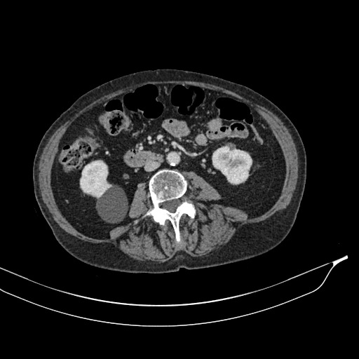 Calcified adrenal glands and Spigelian hernia (Radiopaedia 49741-54988 A 114).jpg
