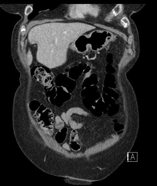 Calcified adrenal glands and Spigelian hernia (Radiopaedia 49741-54988 B 22).jpg
