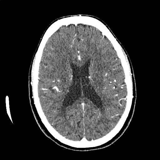 Calcified cerebral hydatid cyst (Radiopaedia 65603-74717 Axial with contrast 46).jpg