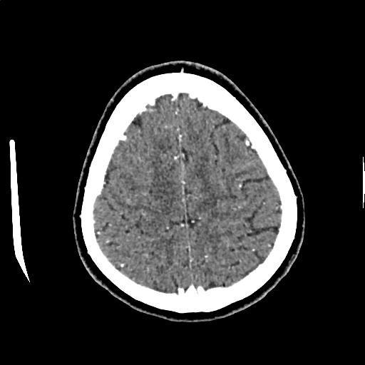 Calcified cerebral hydatid cyst (Radiopaedia 65603-74717 Axial with contrast 66).jpg
