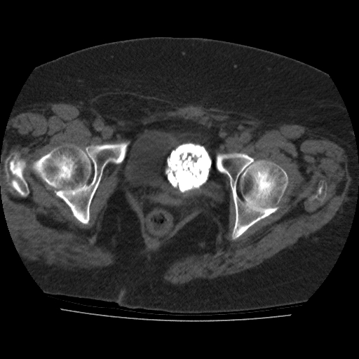 File:Calcified fibroids (Radiopaedia 16853-16579 non-contrast 14).jpg