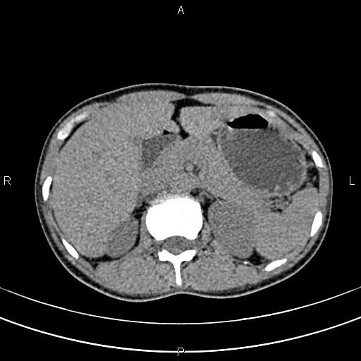 File:Calcified hepatic hydatid cyst (Radiopaedia 83870-99072 Axial non-contrast 54).jpg