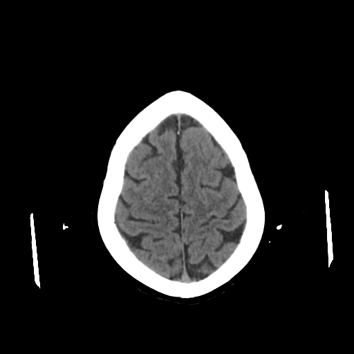 File:Calcified meningioma - cervical canal (Radiopaedia 70136-80171 Axial non-contrast 22).jpg