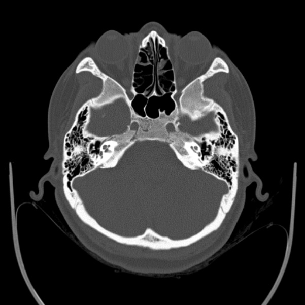 Calvarial osteoma (Radiopaedia 36520-38079 Axial bone window 26).jpg