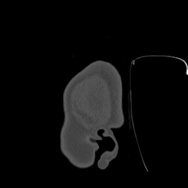 Calvarial osteoma (Radiopaedia 36520-38079 Sagittal bone window 5).jpg