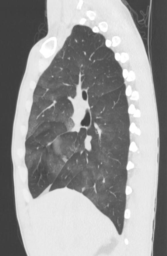 Cannabis-induced diffuse alveolar hemorrhage (Radiopaedia 89834-106946 Sagittal lung window 52).jpg