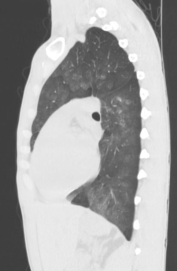 Cannabis-induced diffuse alveolar hemorrhage (Radiopaedia 89834-106946 Sagittal lung window 84).jpg