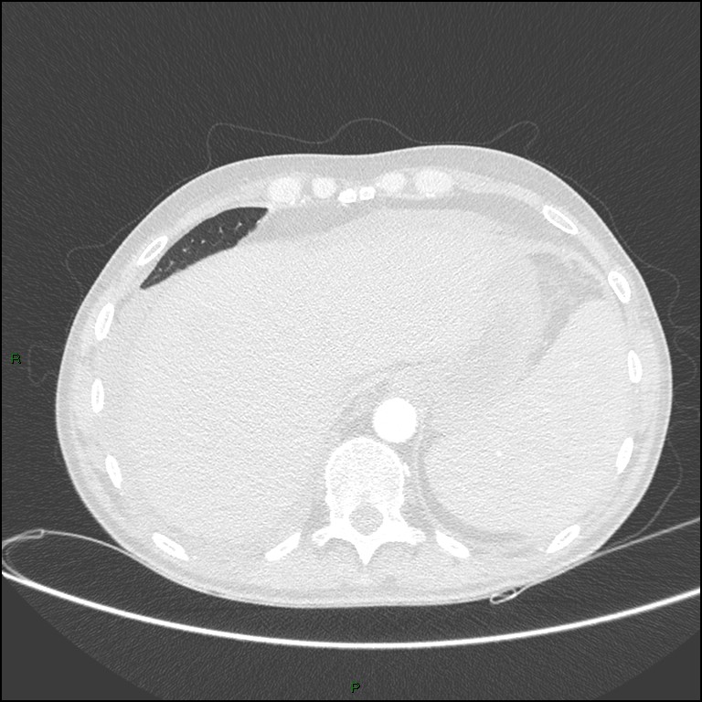 Cannonball metastases (Radiopaedia 82110-96150 Axial lung window 165).jpg