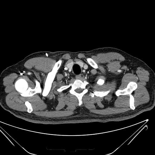 File:Cannonball pulmonary metastases (Radiopaedia 67684-77101 D 16).jpg