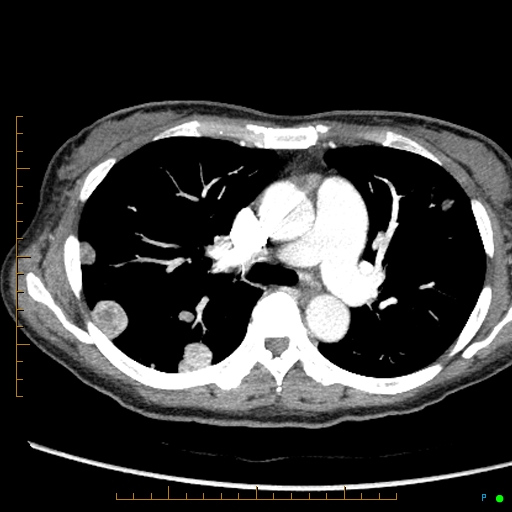 Canonball lung metastasis (Radiopaedia 77634-89837 B 37).jpg