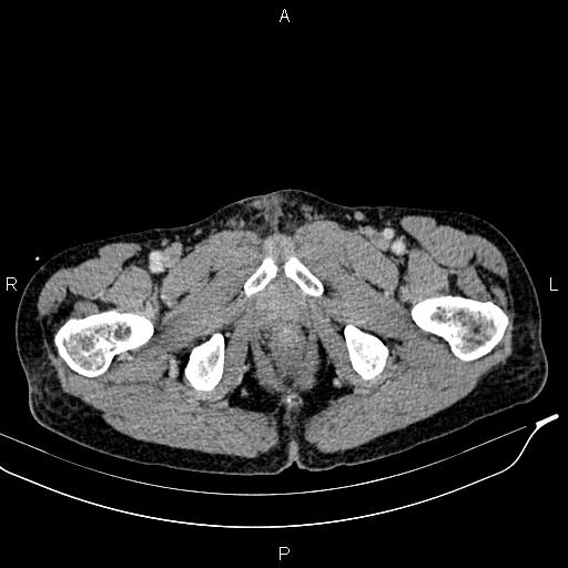 Caput medusae sign - portal hypertension (Radiopaedia 64007-72759 A 106).jpg