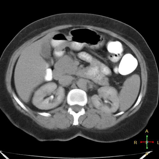File:Carcinoma of sigmoid colon (Radiopaedia 23071-23100 C+ delayed 7).jpg