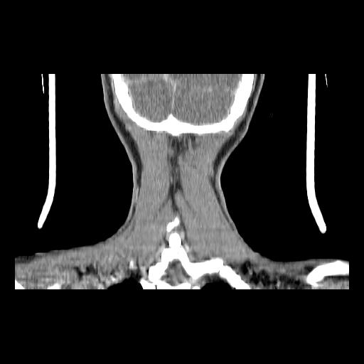 File:Carcinoma of the maxillary antrum (Radiopaedia 53805-59888 Coronal C+ delayed 150).jpg