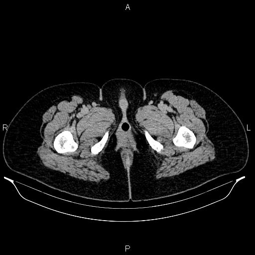 File:Carcinoma of uterine cervix (Radiopaedia 85861-101700 Axial C+ delayed 101).jpg