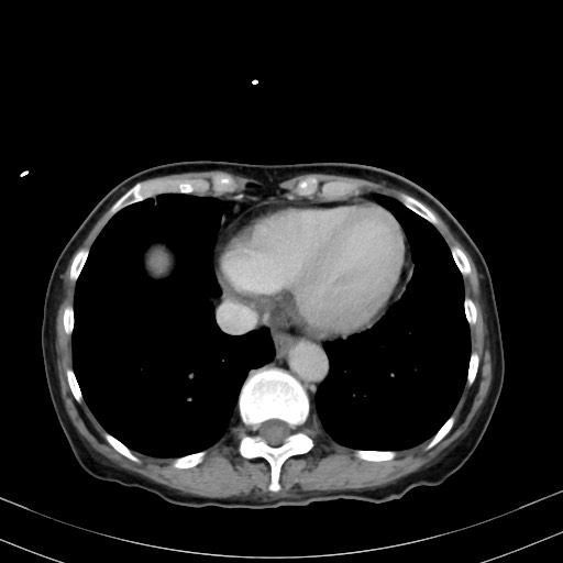 Carcinosarcoma (Radiopaedia 70401-80503 A 3).jpg