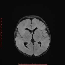 File:Cardiac rhabdomyoma - tuberous sclerosis (Radiopaedia 70089-80114 Axial FLAIR 11).jpg