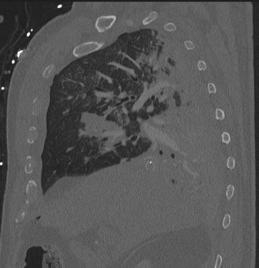 Cardiac trauma (Radiopaedia 32874-33858 Sagittal bone window 79).jpg