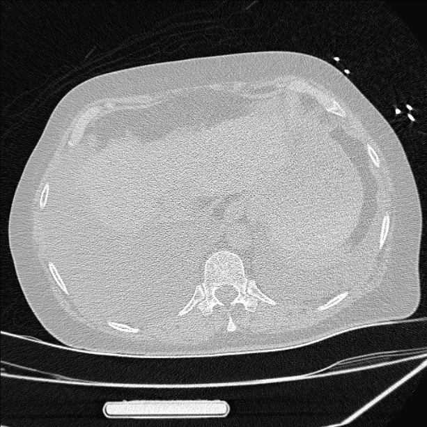 Cardiogenic pulmonary edema (Radiopaedia 29213-29609 Axial lung window 90).jpg