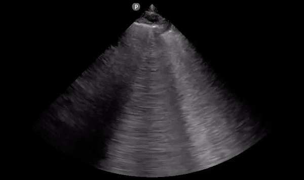 File:Cardiogenic pulmonary edema (ultrasound) (Radiopaedia 62735-71050 A 1).gif